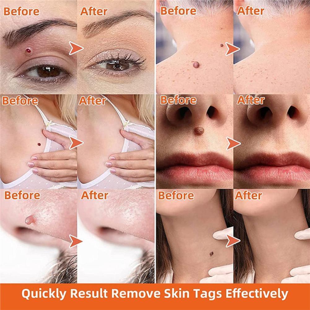 Auto Skin Tag Remover Painless 2