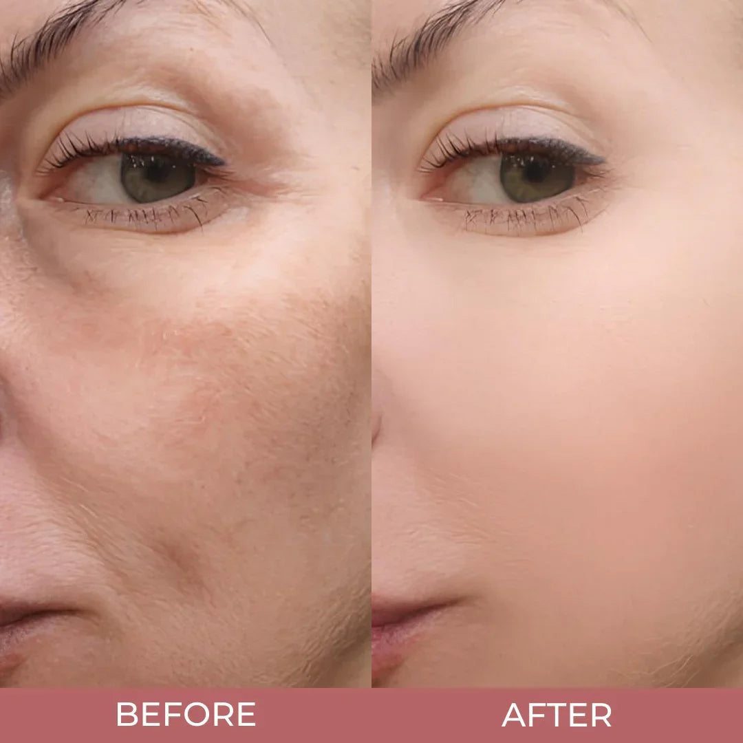 Pore Refining Rice Ampoule Serum for Women | Rice Bran Water & Clinical Acid Formula | Reduces Blackheads & Enlarged Pores